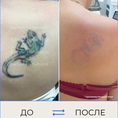 Удаление татуировки